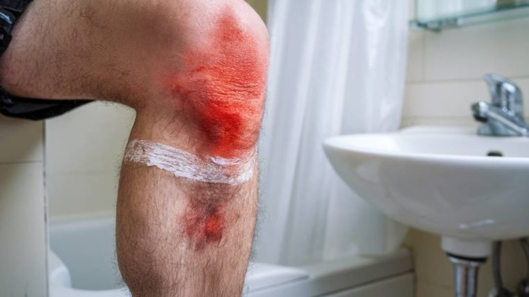 how to prevent razor burn and ingrown hairs: expert tips